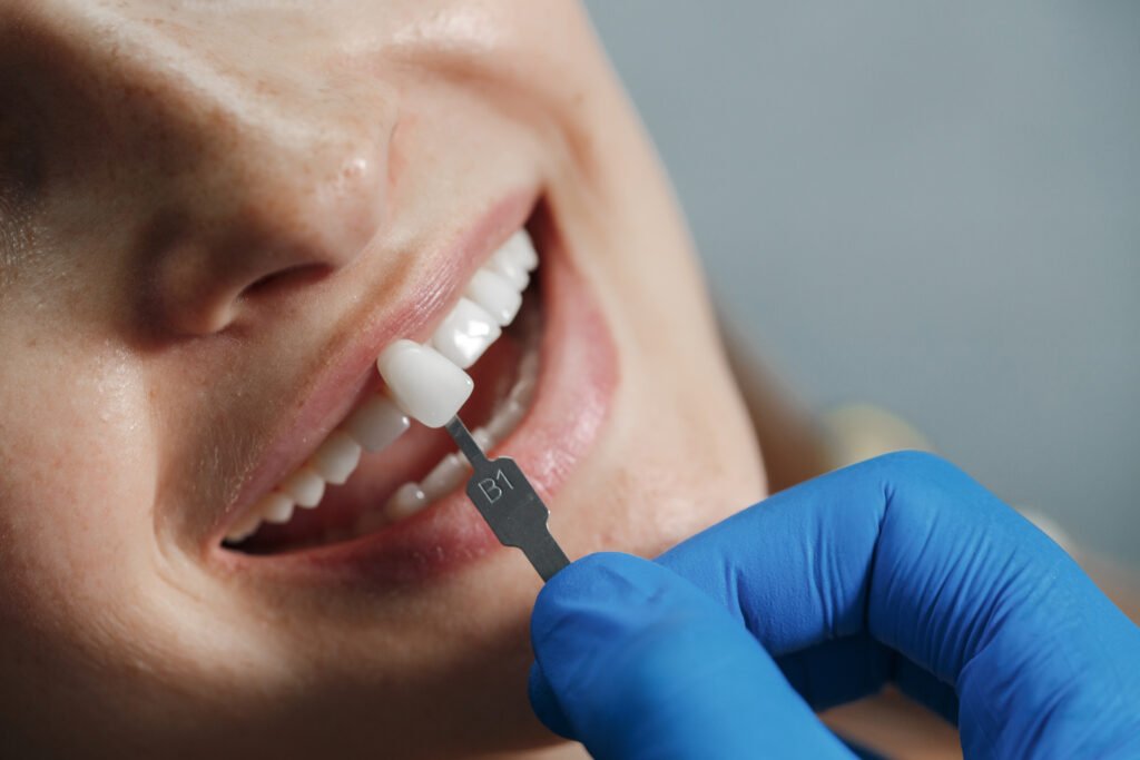 Benefits of Dental Implants