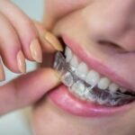 Braces vs Aligners: Which is Better?